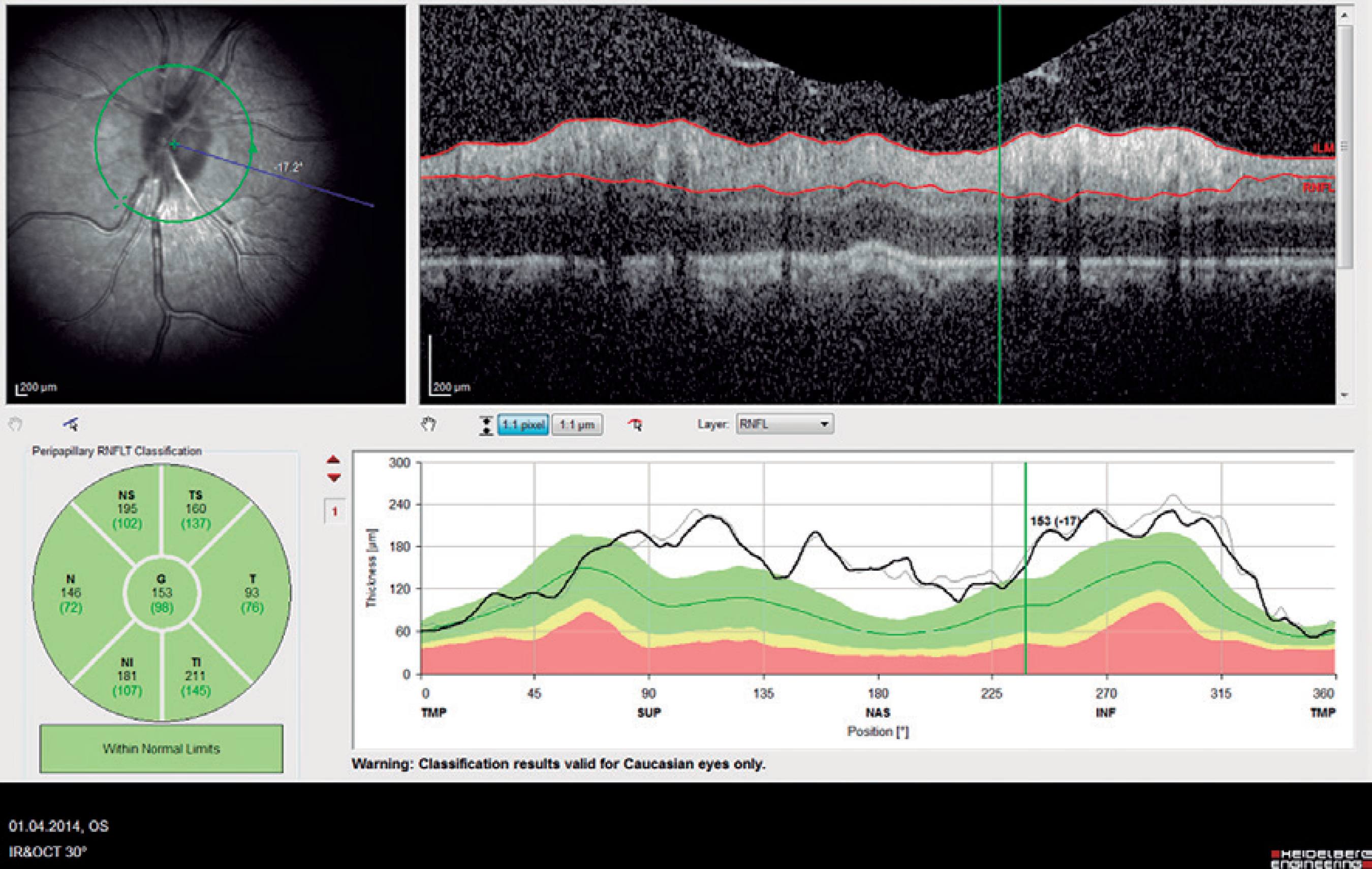 retina vizsgálat riciniol és látás